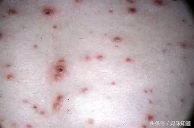 春暖花开要预防过敏性皮肤疾病,春暖花开一定要小心四种虫