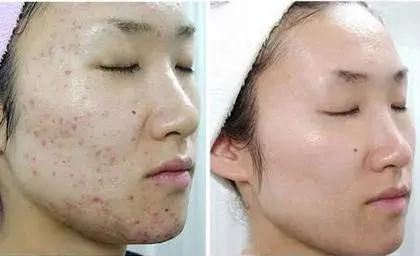 祛痘产品排行榜10强品牌图片,祛痘产品排行榜10强学生