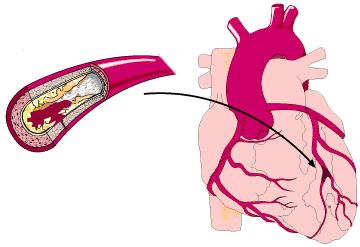 40岁高血压冠状动脉粥样硬化,40岁人就有高血压怎样解决