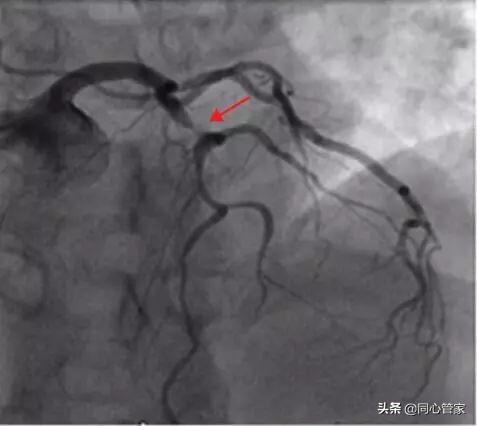 斑块和血栓ct区别,斑块和血栓的超声鉴别
