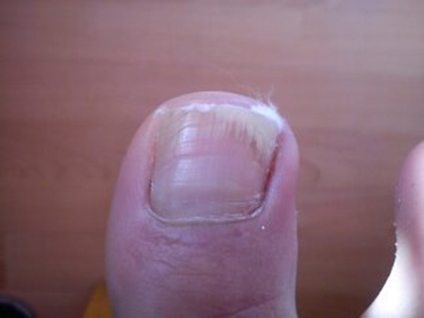 甲沟炎剪指甲的正确方式,甲沟炎剪指甲的正确方法