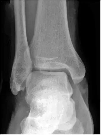 踝关节撞击症问诊,踝关节撞击综合征的x线表现