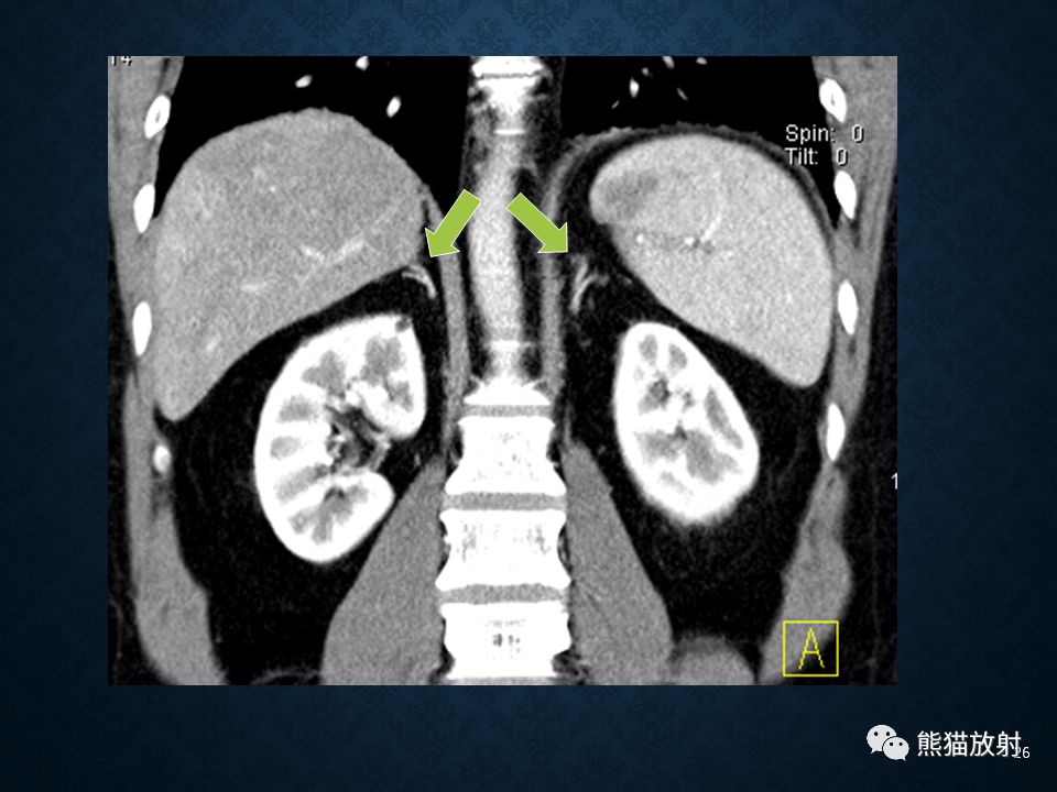 纵隔和肾上腺恶性肿瘤,纵隔性肿瘤位置图