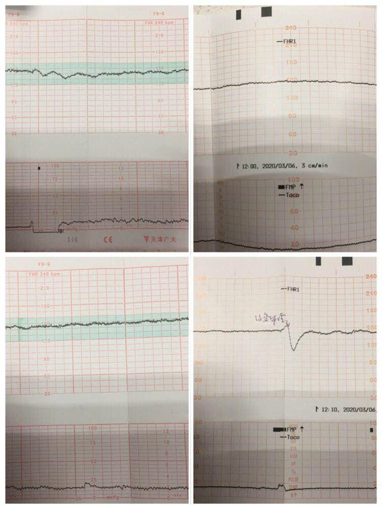 宝宝胎动是怎样的信号,胎动是如何的