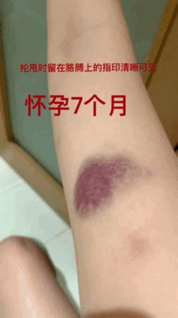 短跑名将张培萌家暴事件,短跑名将张培萌被控家暴