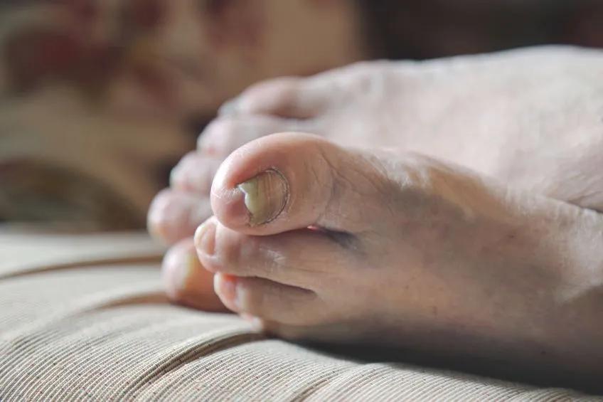 肿瘤会引起半身麻木吗,手脚发麻是癌症的征兆吗