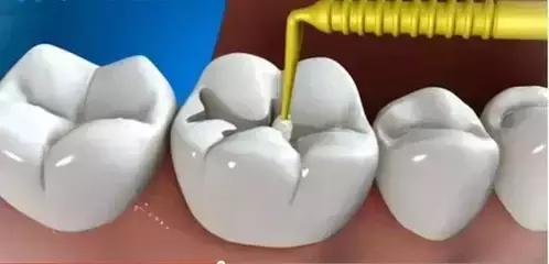 补牙后为什么会难受,补牙过后为什么还会牙痛