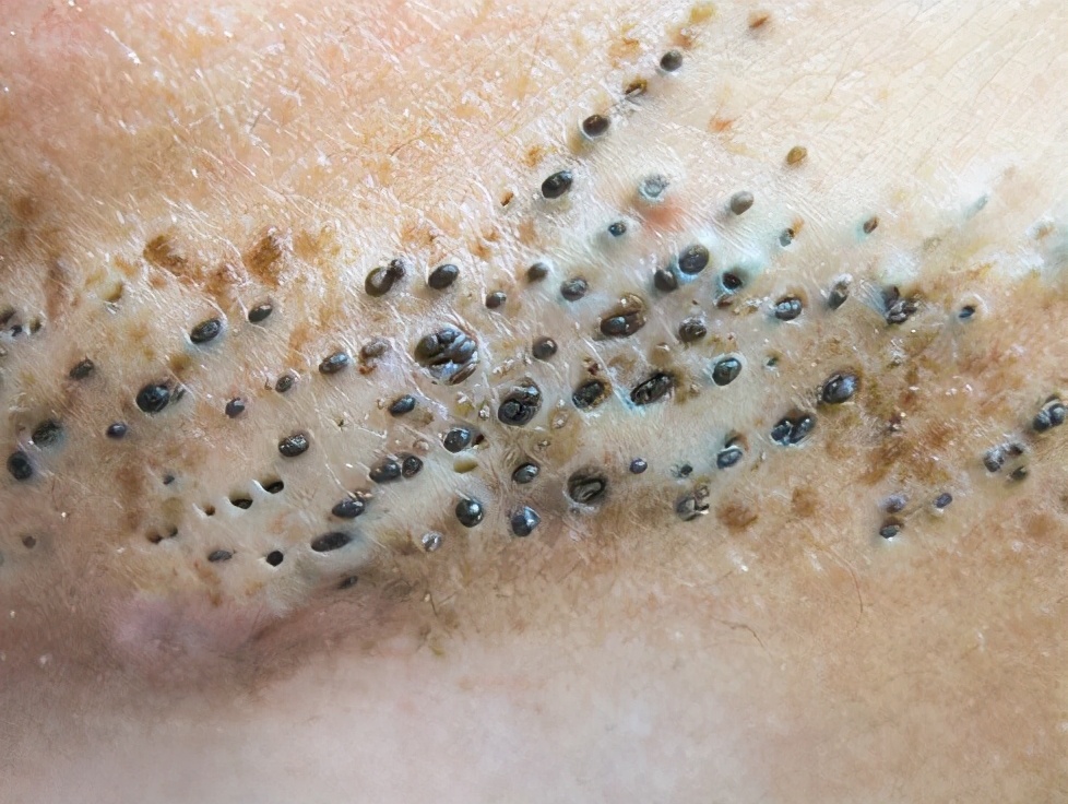 脸上长粉刺该怎么去除啊,脸上长粉刺怎么护肤比较好