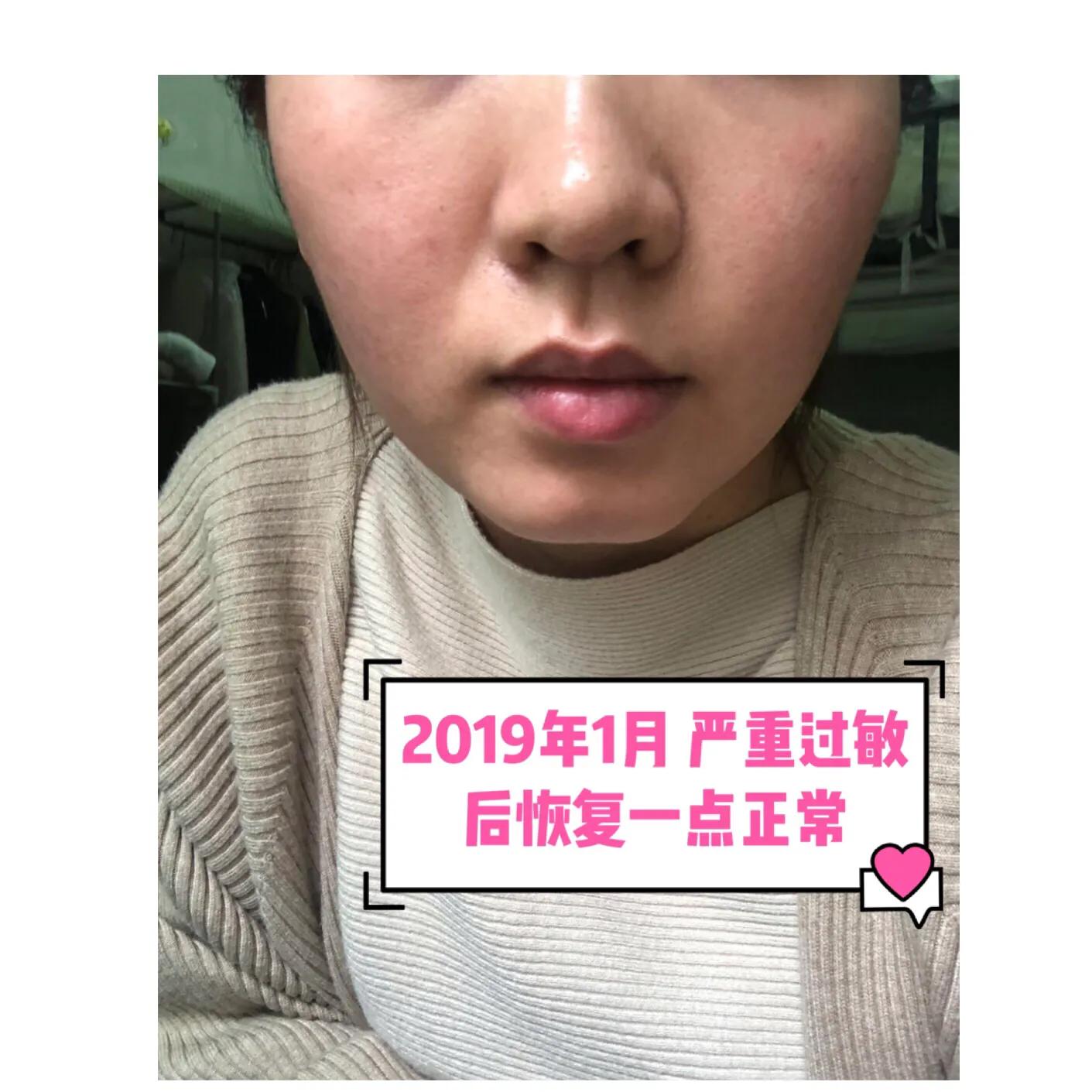 与病魔对抗的第30天,激素脸排毒第31天