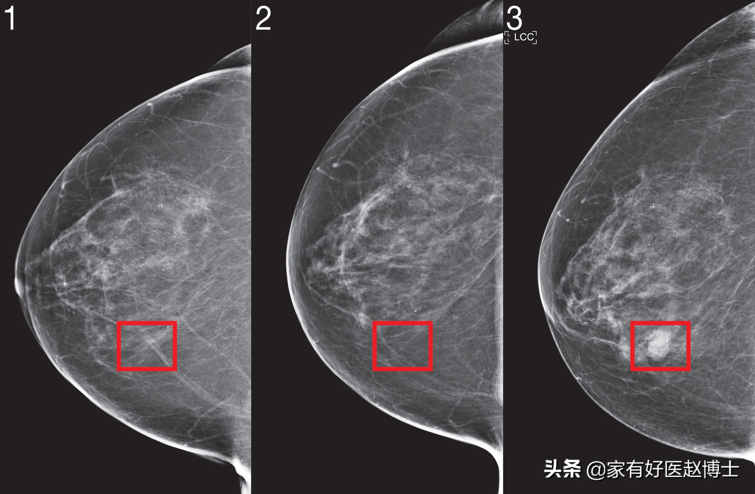 六大高发癌症早筛攻略,六大癌症有哪些