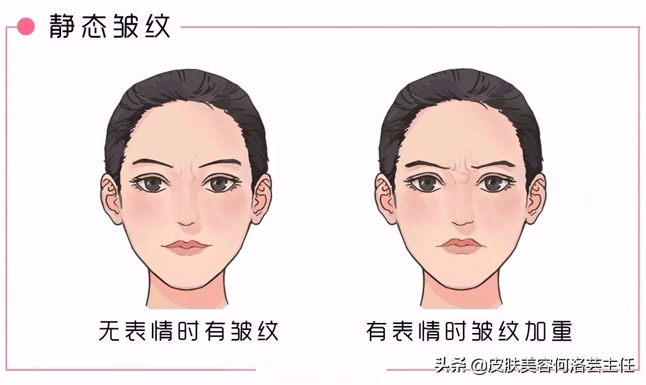 长皱纹多了用什么方法去皱纹最好,长皱纹了怎么救