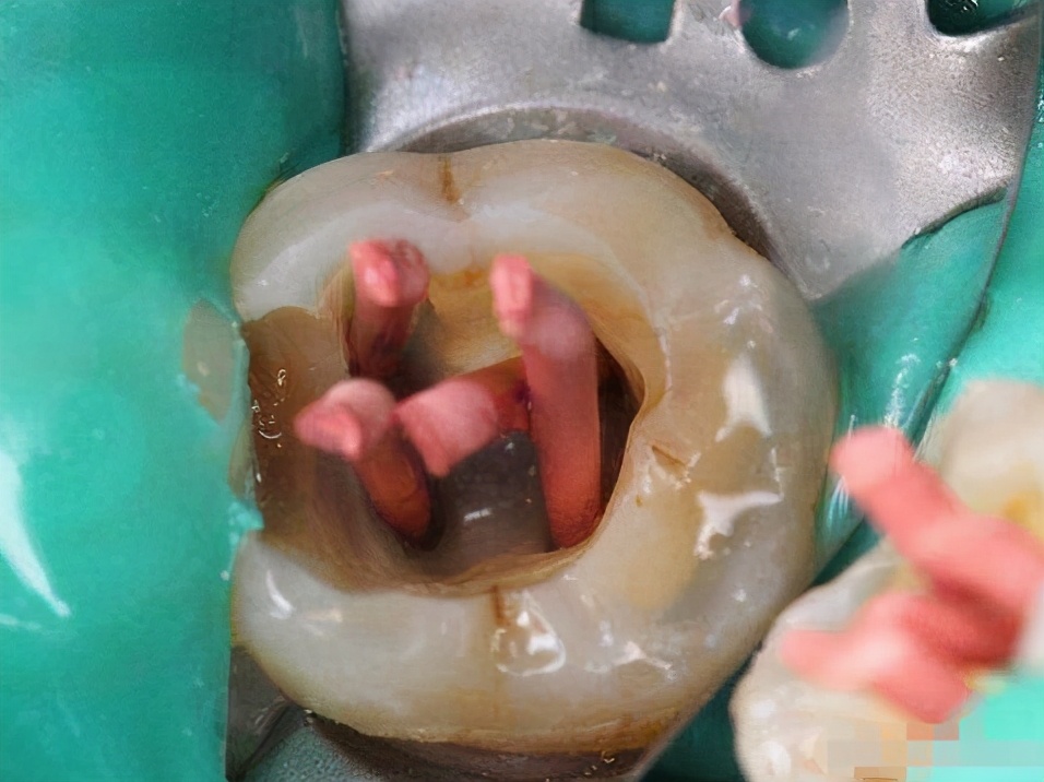 牙痛神经发炎,牙痛到什么程度需要抽牙神经