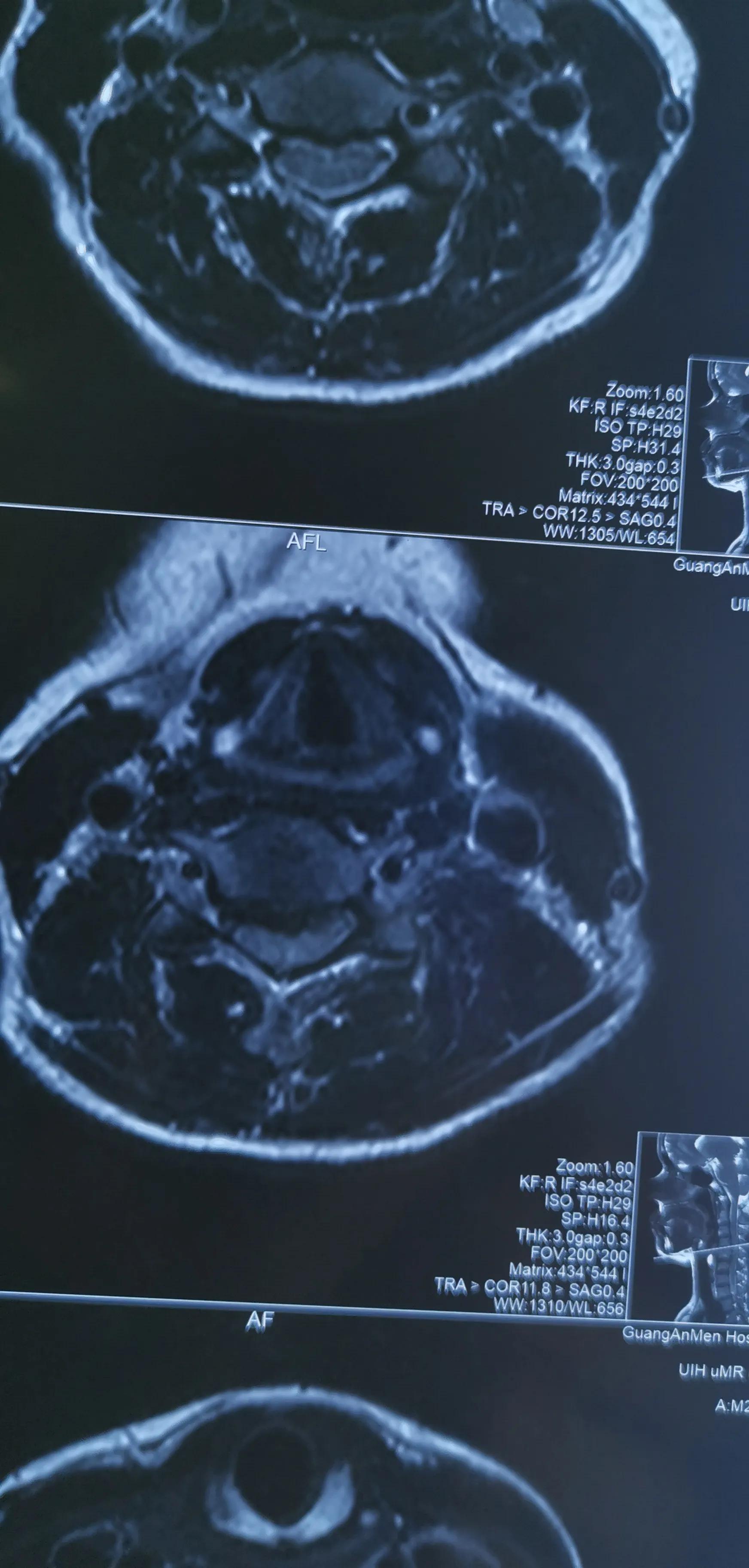 颈椎椎间盘轻度切除,颈椎全切除