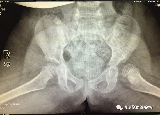 先天性髋关节脱位,先天性髋关节脱位属不属于残疾人