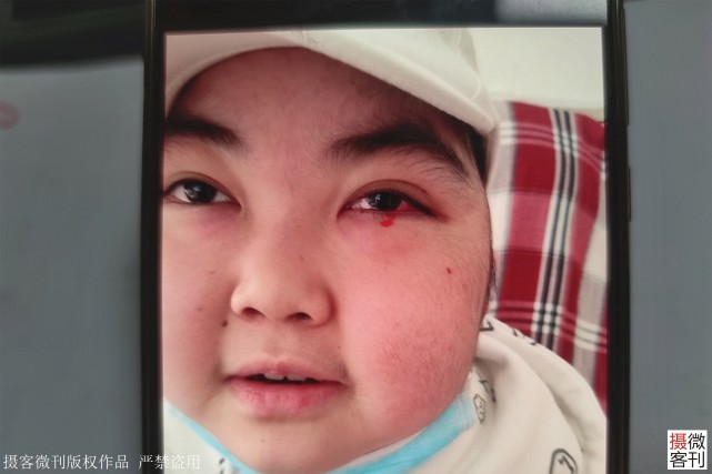 13岁女孩白血病3年花了80万,13岁女孩白血病3年花了80万捐款