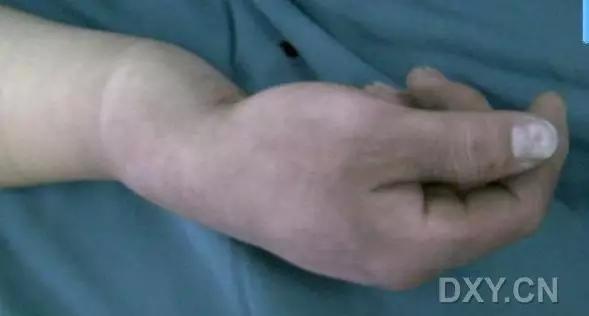 几种严重骨折医学名称,常见的骨折有哪些名称