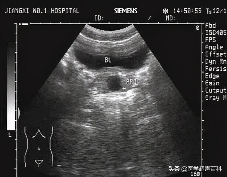 彩超前列腺囊肿是怎么回事,前列腺炎超声检查出现单个小囊肿