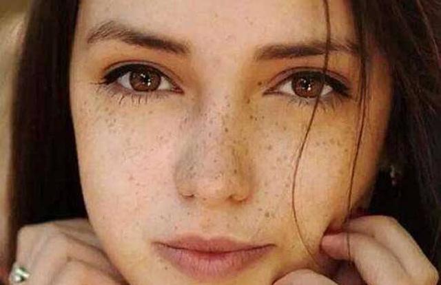 褐黄病需要注意的事项,褐斑能彻底去除吗