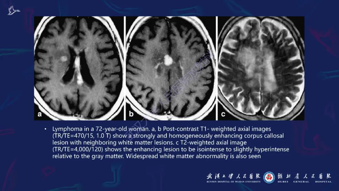 胼胝体肿瘤影像鉴别,胼胝体病变影像诊断