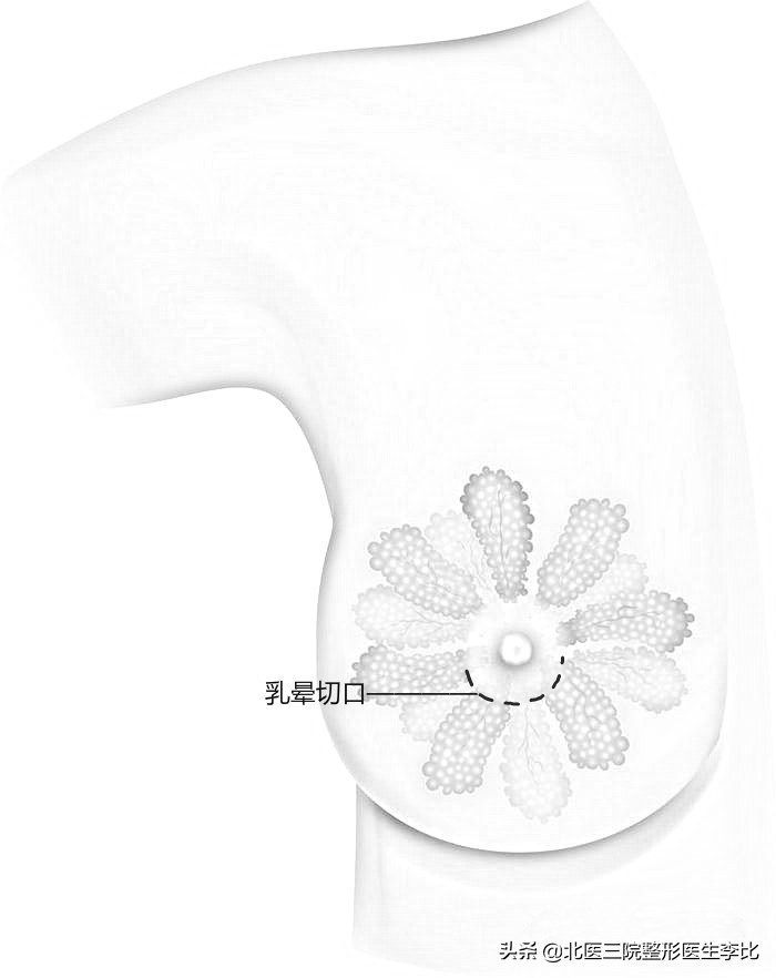 假体隆胸各种切口的优缺点,假体隆胸哪个切口最合适