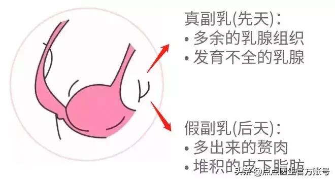 副乳怎么消除腋下赘肉,腋下凸起的肉肉是赘肉还是副乳