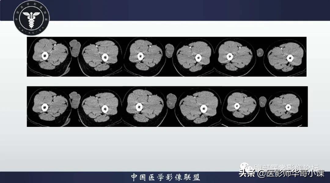 [精品课件]畸胎瘤及精原细胞瘤（*丸睾**肿瘤及肿瘤样变CT及MR表现）
