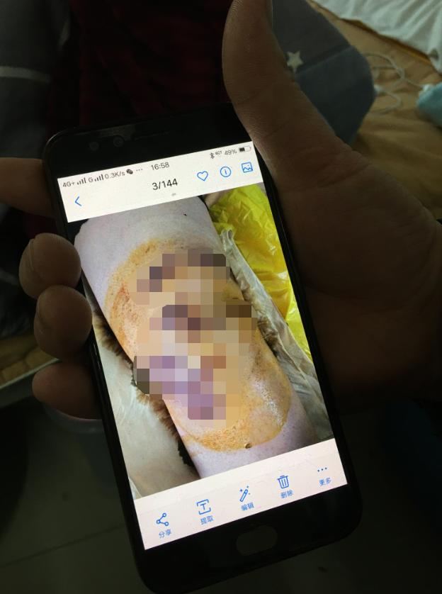 针灸感染,河南诊所针灸感染