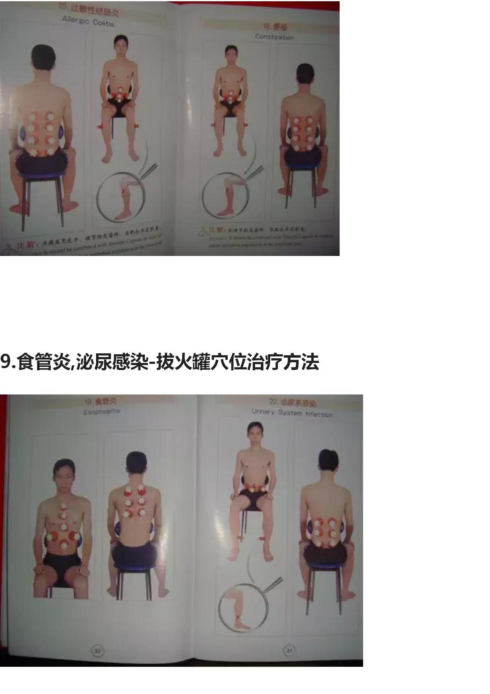 拔罐的手法和穴位图,中医拔罐穴位图片及作用