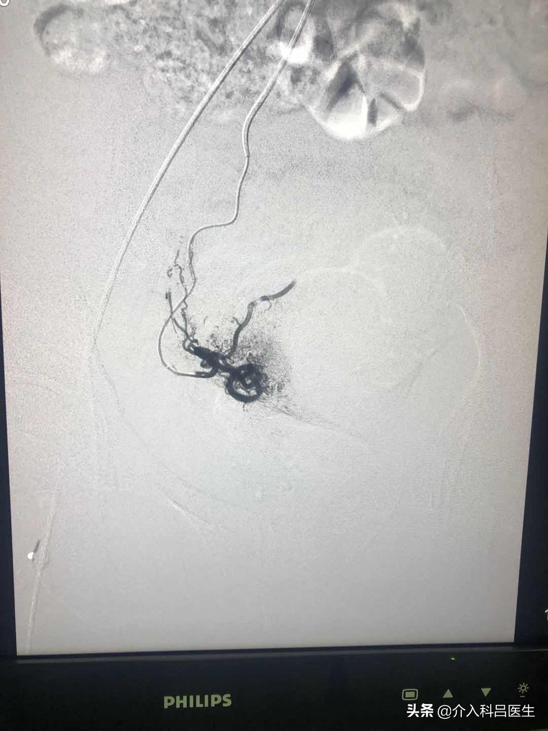 子宫腺肌症+巧囊很棘手？医生一根针，改变子宫内部环境