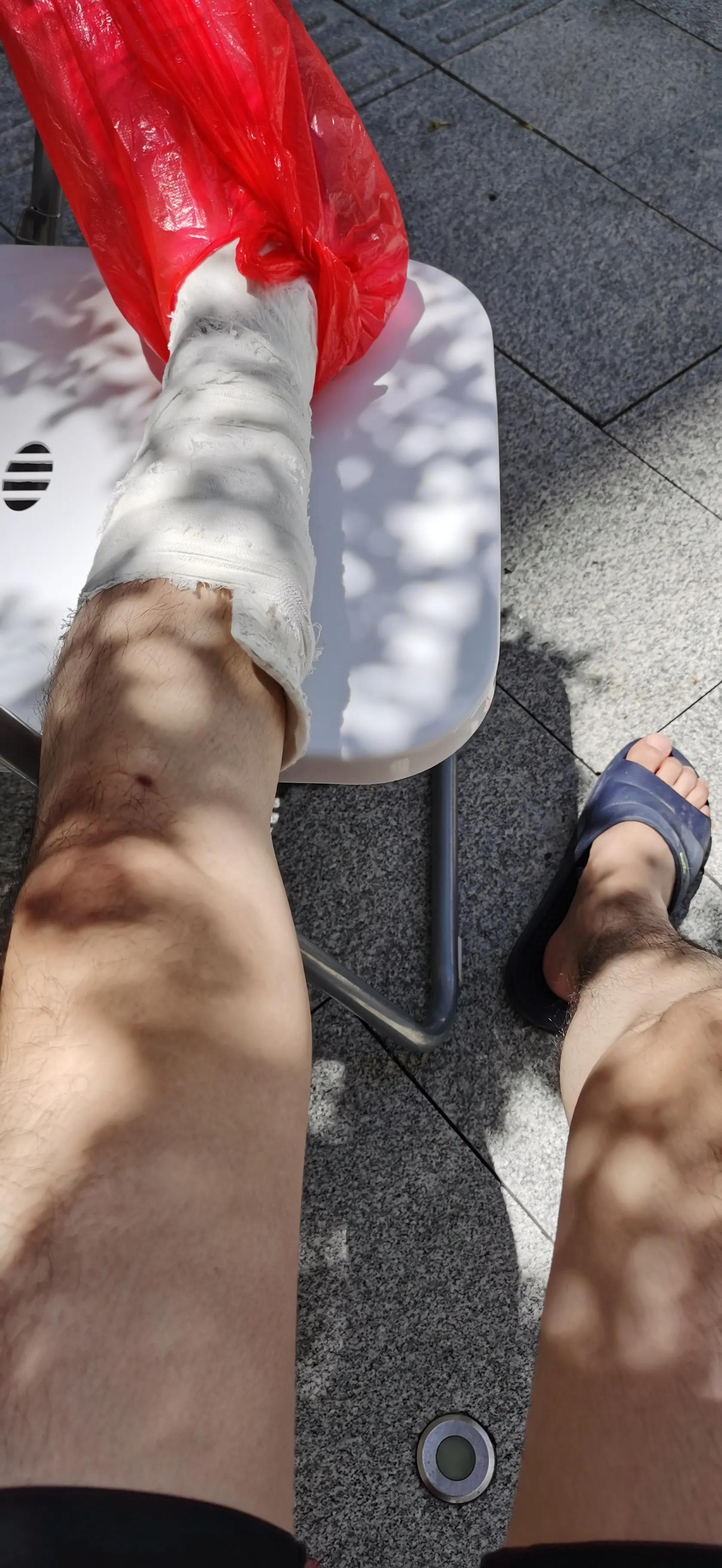 第五跖骨基底部骨折60天能走路吗,第五跖骨基底部骨折60天能脱拐吗