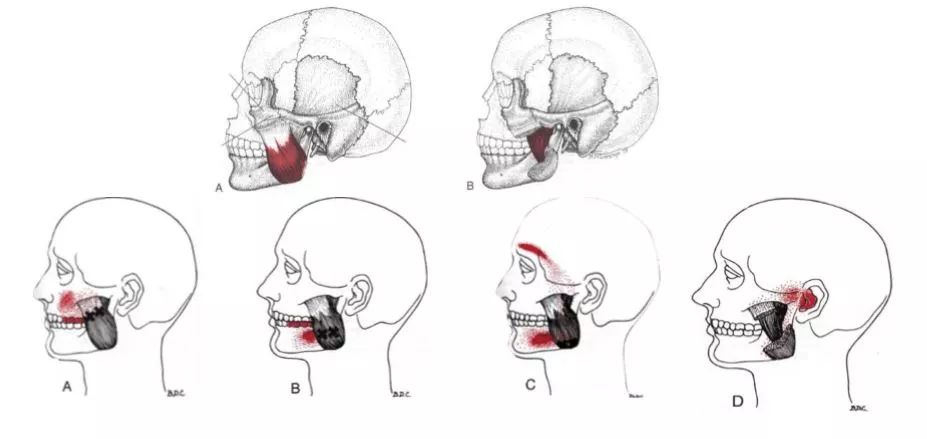 每日一肌大臂疼,牙疼咬肌肿了