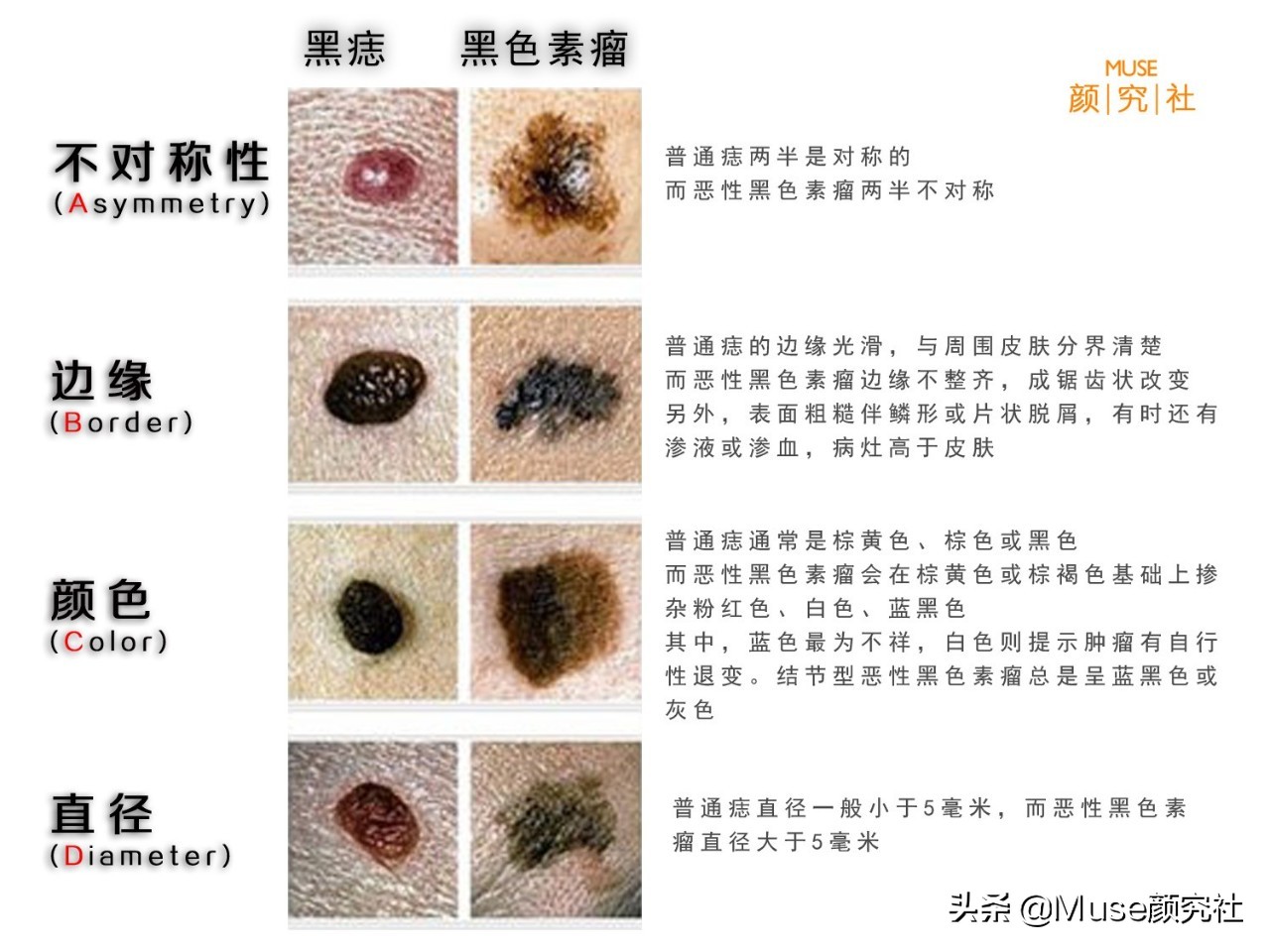 脸上长痦子是有福吗,脸上很容易长痣是什么原因