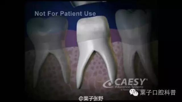 牙龈反复鼓包流脓是牙齿坏了吗,一上火牙龈就鼓包