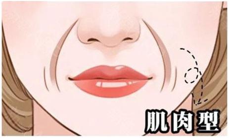 法令纹都是有什么方法可以去除,去法令纹最有效的办法明星