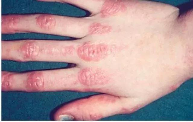 皮肌炎或多发性肌炎的诊断标准,成人皮肌炎与儿童皮肌炎区别