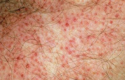 前胸后背长痘痘是毛囊炎吗,前胸后背很容易长痘痘中医治疗