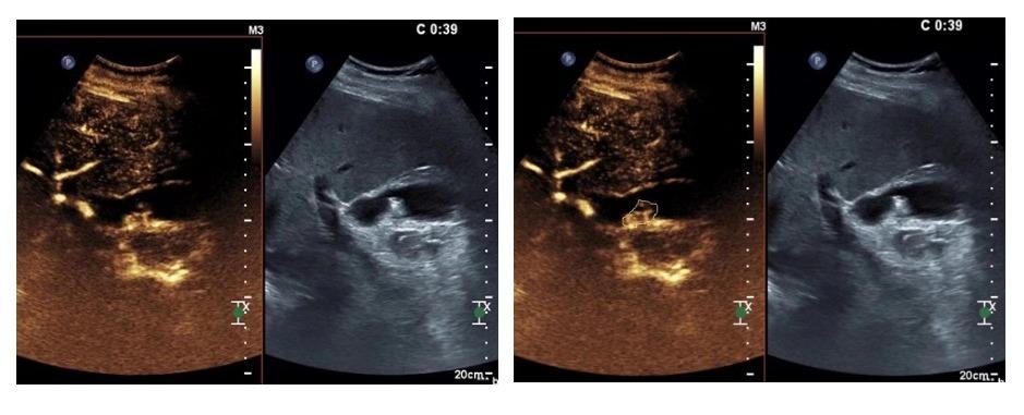 胆囊息肉消融保胆有效吗,胆囊息肉消融保胆有用吗