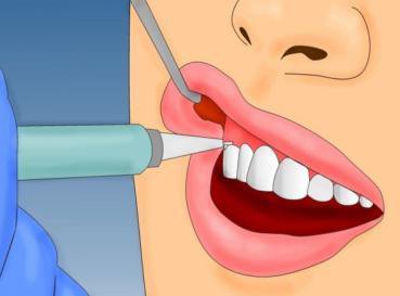 拔牙后的血洞是什么样的,拔牙后血窟窿恢复视频