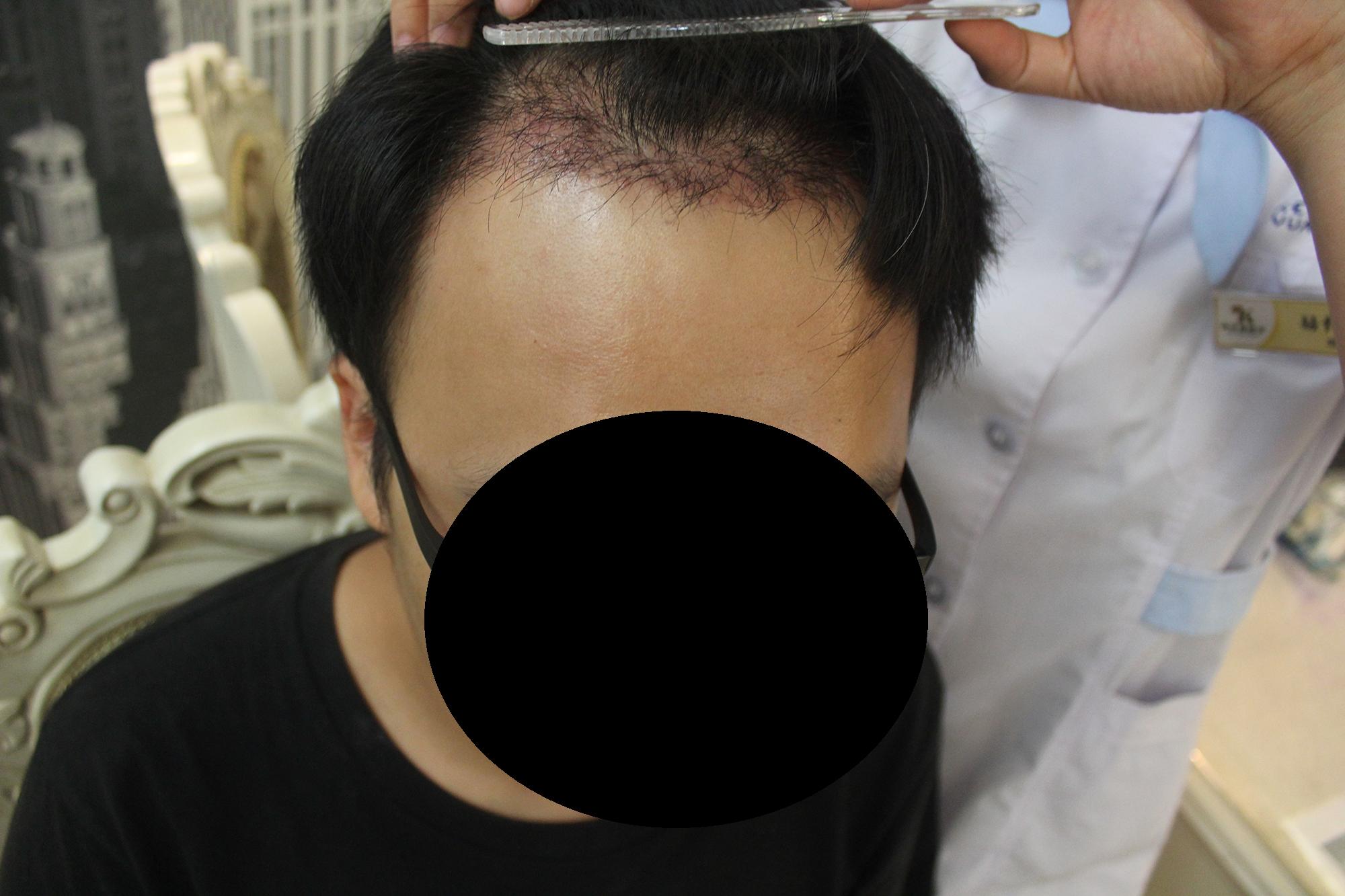 植发靠谱吗,植发价格一般多少钱