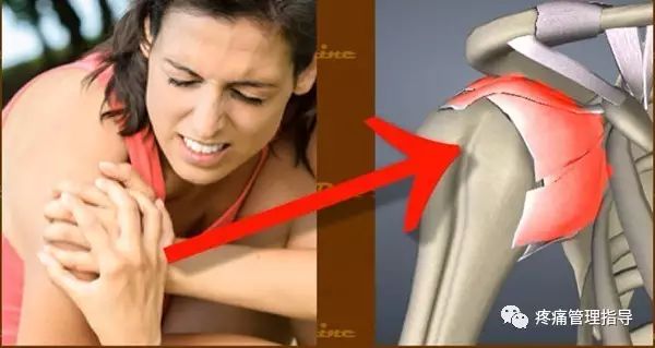 肩周炎的原因与锻炼方法