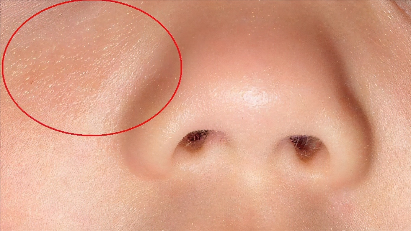 鼻子上挤出来的白色丝状物，看起来像一条虫子，是螨虫吗？