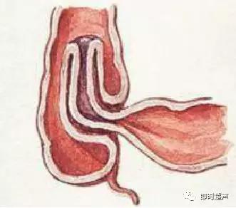 小儿消化道急症超声