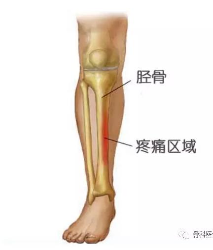 跑完步后小腿迎面骨按压痛,小腿前侧迎面骨疼