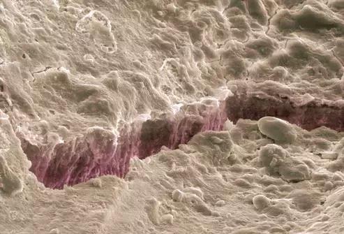 牙齿隐裂拔牙需要种植吗,牙齿裂一半深度还需要拔牙吗