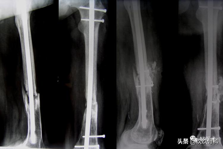 髓内钉技巧,髓内钉教学视频讲解