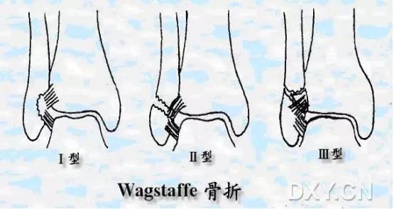 几种严重骨折医学名称,常见的骨折有哪些名称