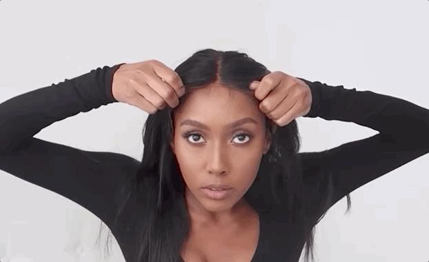 一招教你解决发际线后移,发际线秃了怎么拯救真实案例