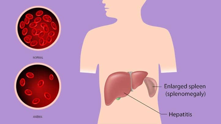 乙肝患者肝硬度值9,乙肝患者肝硬度多少是正常的