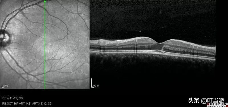 警惕这种笔容易伤害视力,损害视力的新型文具