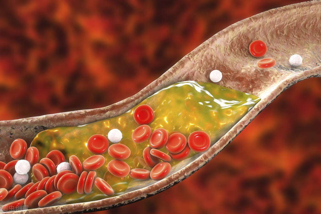 治疗高脂血症吃哪种中药好,高脂血症用什么降脂药